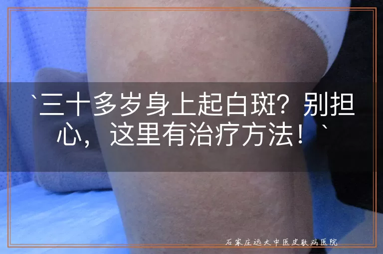 三十多岁身上起白斑？别担心，这里有治疗方法！