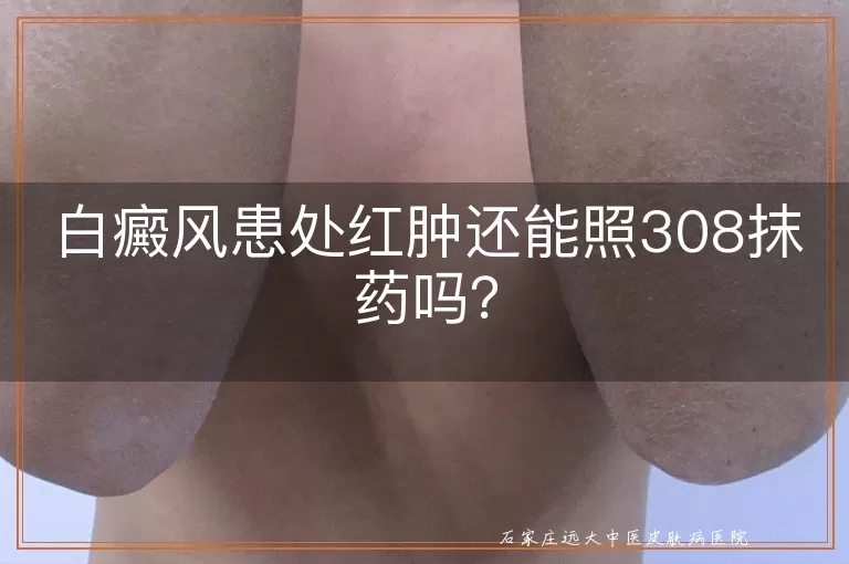 白癜风患处红肿还能照308抹药吗？