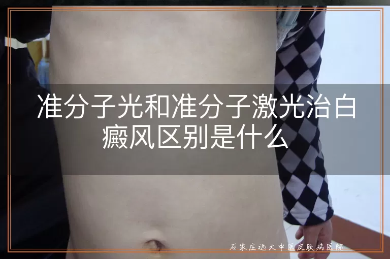 准分子光和准分子激光治白癜风区别是什么