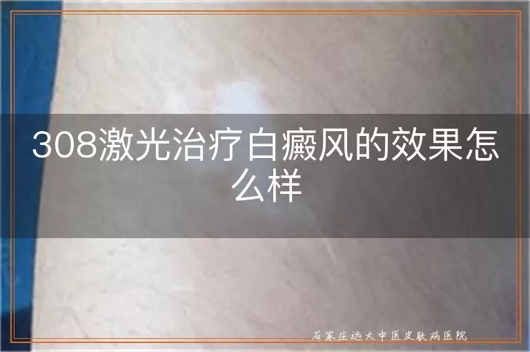 308激光治疗白癜风的效果怎么样