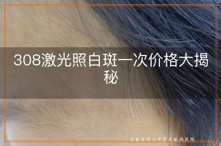 308激光照白斑一次价格大揭秘