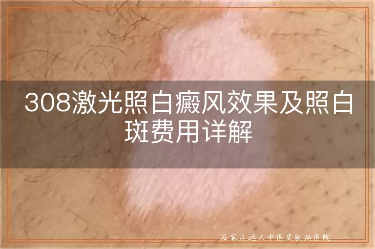 308激光照白癜风效果及照白斑费用详解