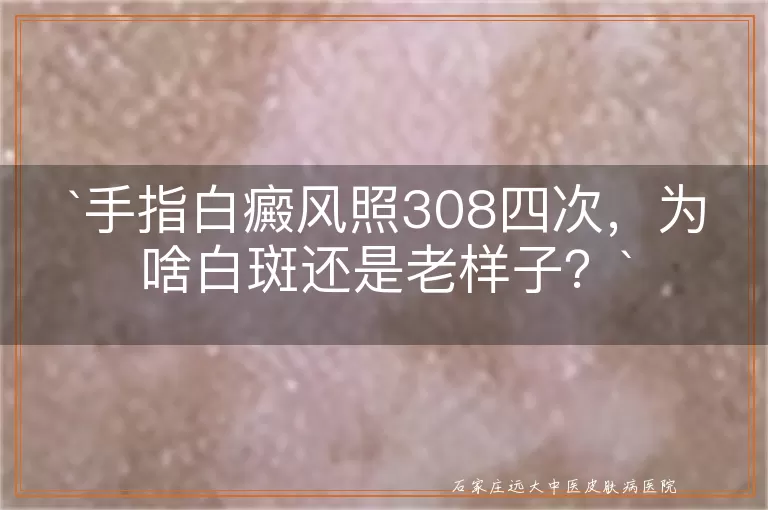 手指白癜风照308四次，为啥白斑还是老样子？