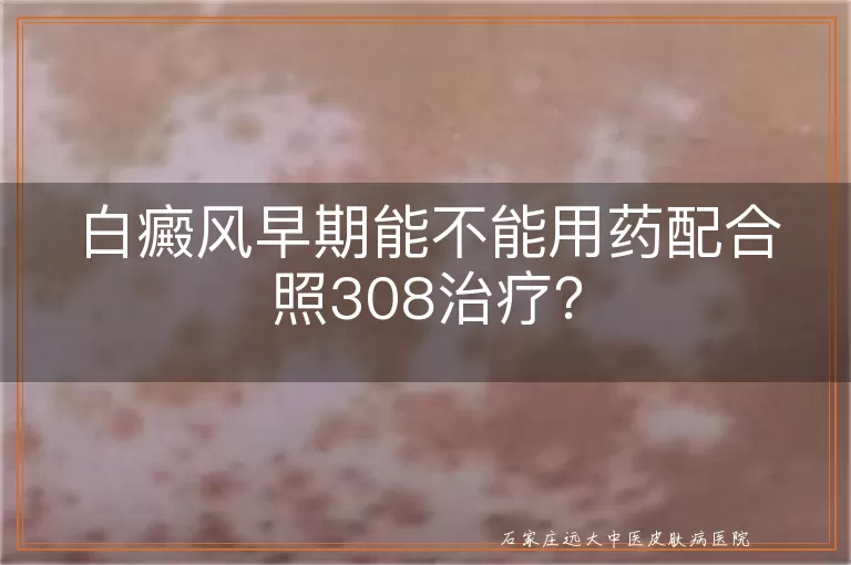 白癜风早期能不能用药配合照308治疗？