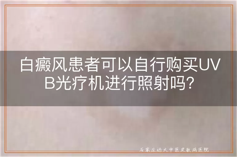 白癜风患者可以自行购买UVB光疗机进行照射吗？