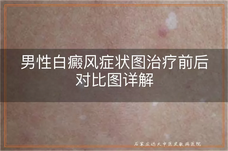 男性白癜风症状图治疗前后对比图详解