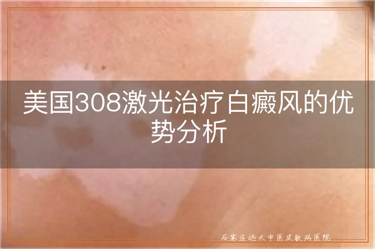 美国308激光治疗白癜风的优势分析