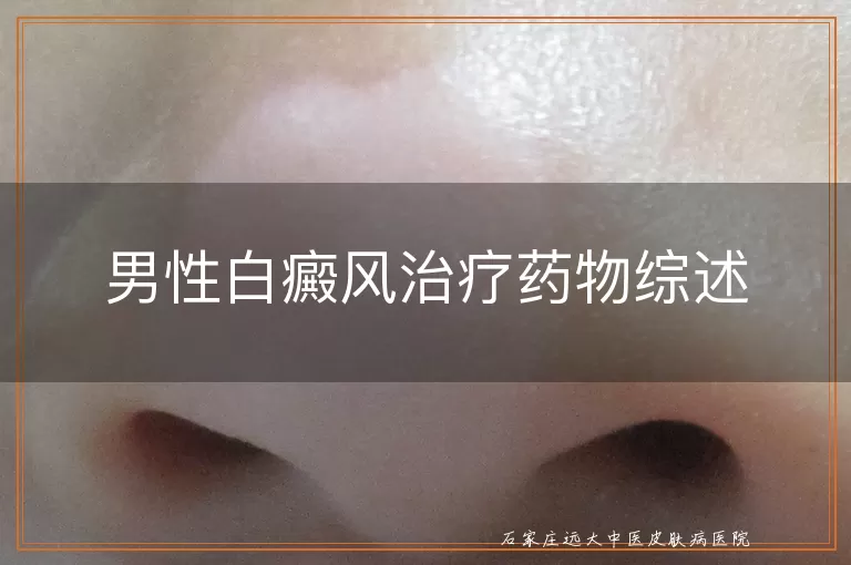 男性白癜风治疗药物综述