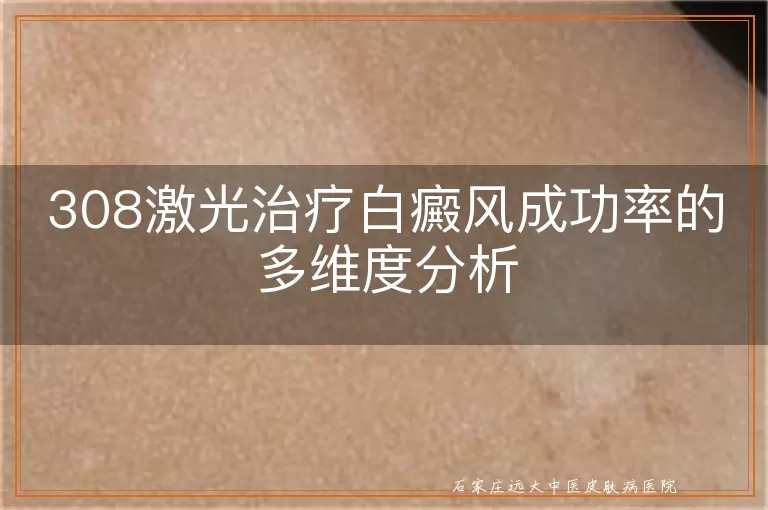 308激光治疗白癜风成功率的多维度分析