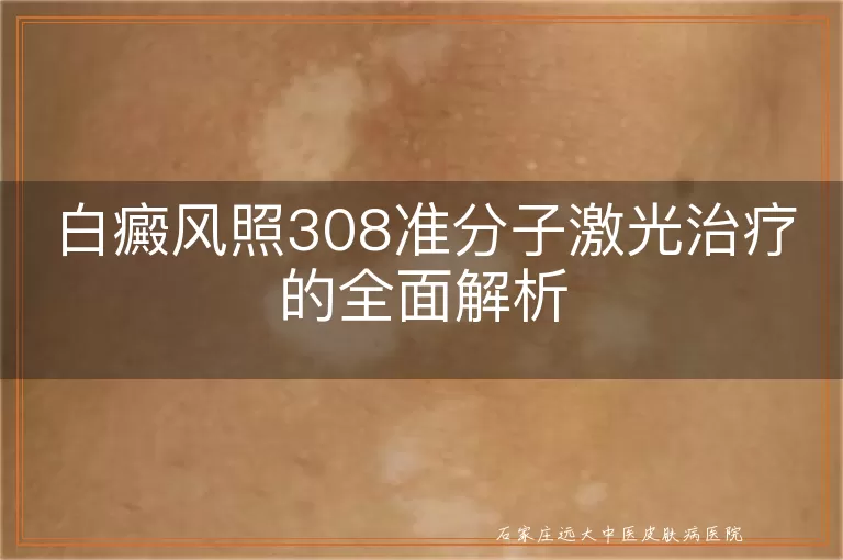 白癜风照308准分子激光治疗的全面解析