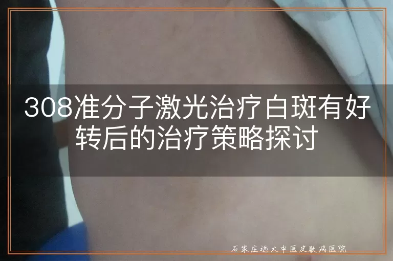 308准分子激光治疗白斑有好转后的治疗策略探讨