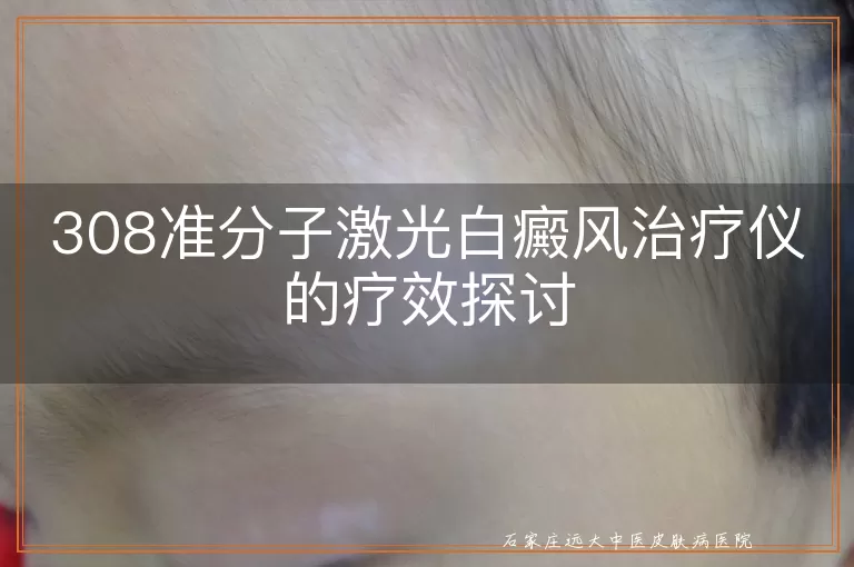 308准分子激光白癜风治疗仪的疗效探讨