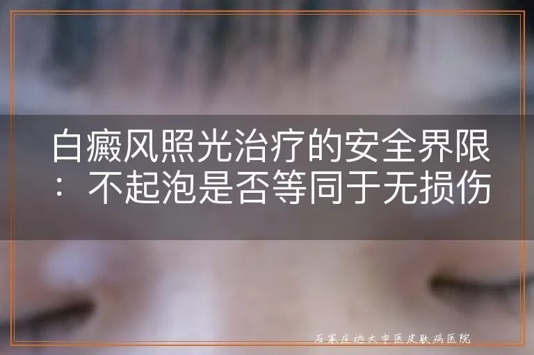 白癜风照光治疗的安全界限：不起泡是否等同于无损伤？