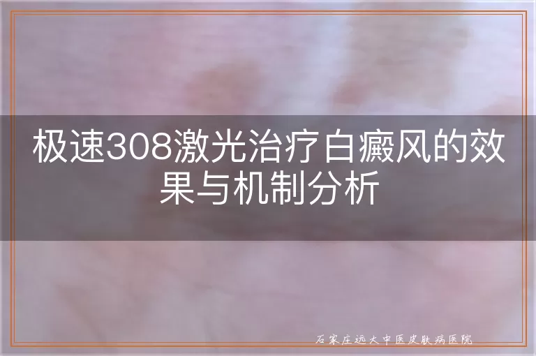 极速308激光治疗白癜风的效果与机制分析