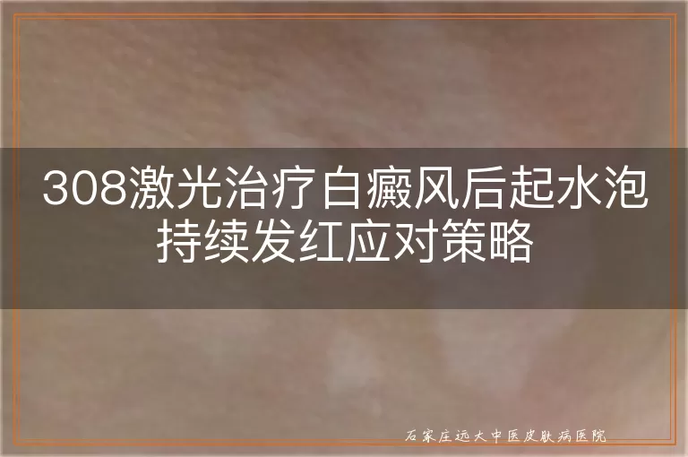 308激光治疗白癜风后起水泡持续发红应对策略