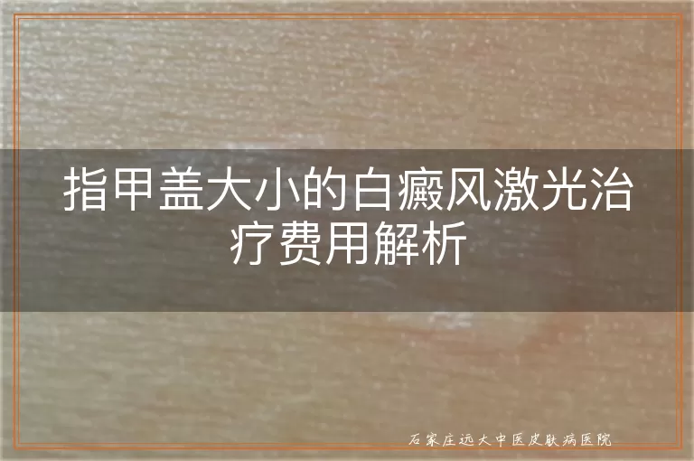 指甲盖大小的白癜风激光治疗费用解析