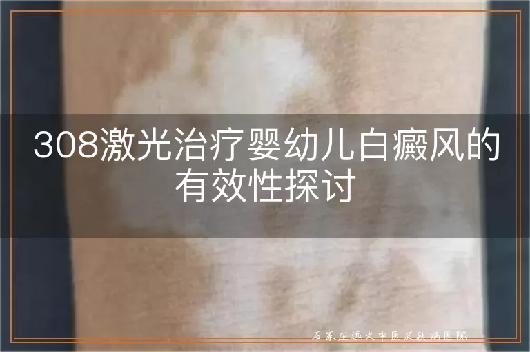 308激光治疗婴幼儿白癜风的有效性探讨