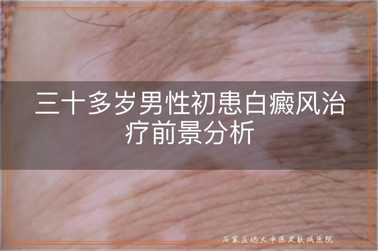 三十多岁男性初患白癜风治疗前景分析