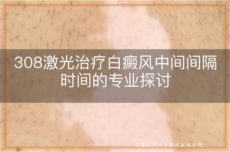 308激光治疗白癜风中间间隔时间的专业探讨