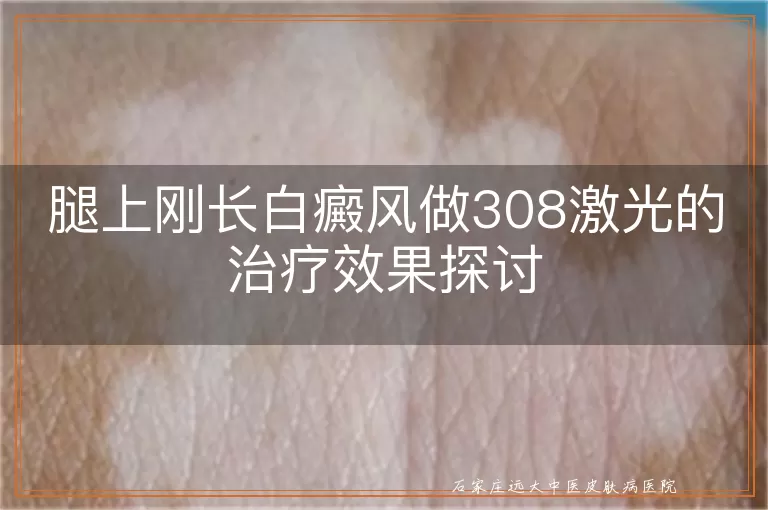 腿上刚长白癜风做308激光的治疗效果探讨