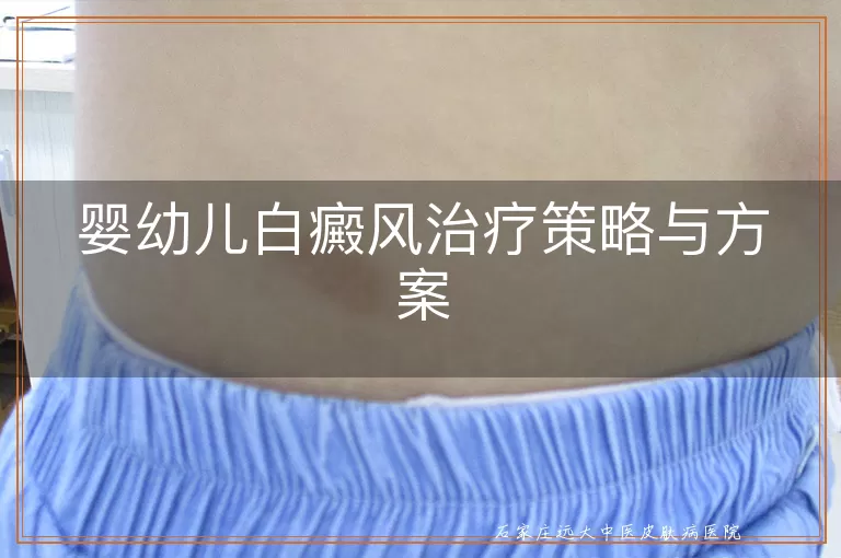 婴幼儿白癜风治疗策略与方案