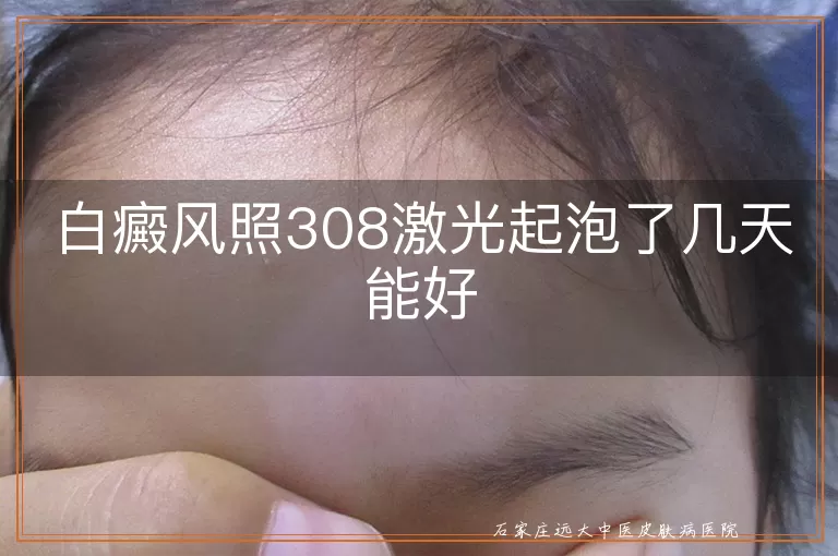 白癜风照308激光起泡了几天能好