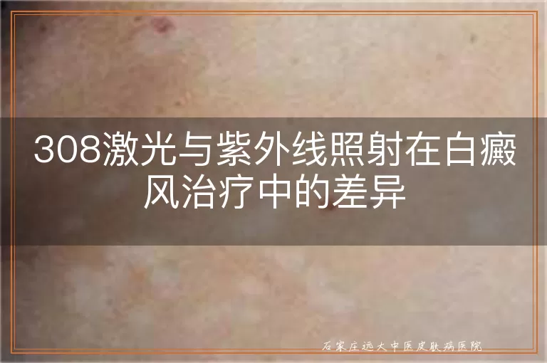 308激光与紫外线照射在白癜风治疗中的差异