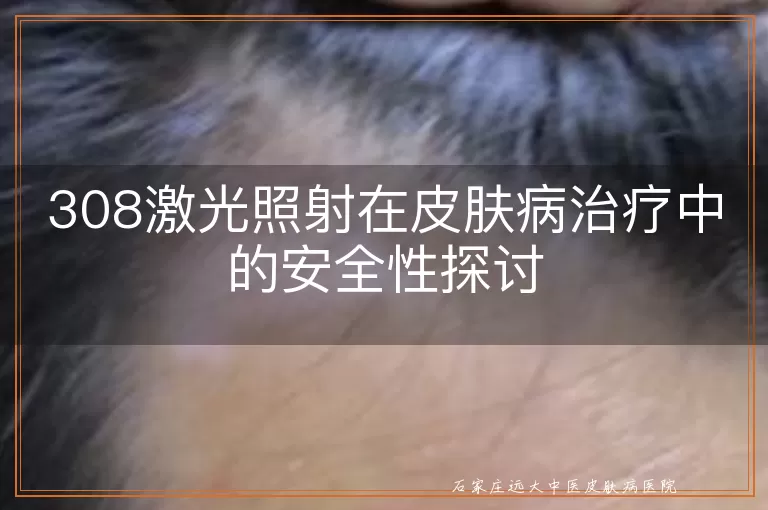 308激光照射在皮肤病治疗中的安全性探讨