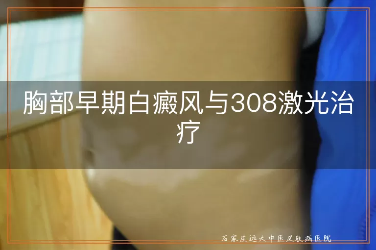 胸部早期白癜风与308激光治疗