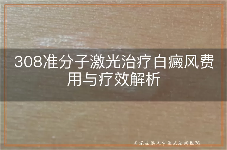 308准分子激光治疗白癜风费用与疗效解析
