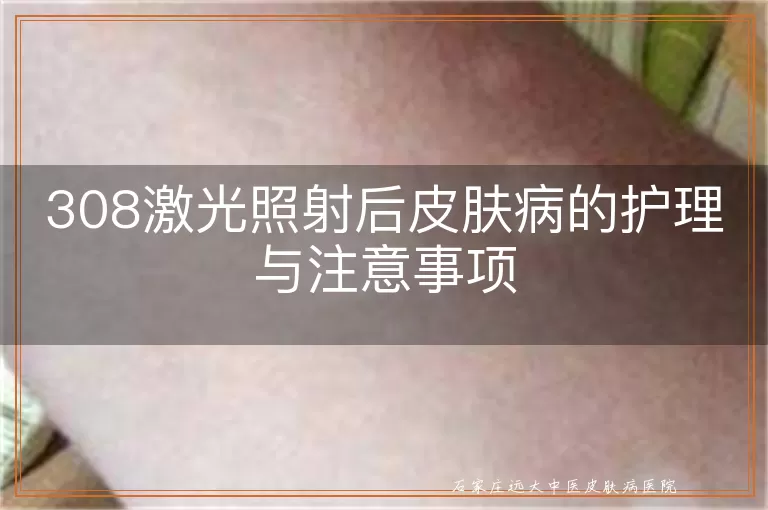 308激光照射后皮肤病的护理与注意事项