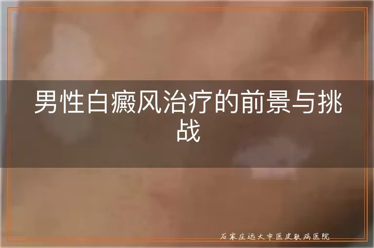 男性白癜风治疗的前景与挑战