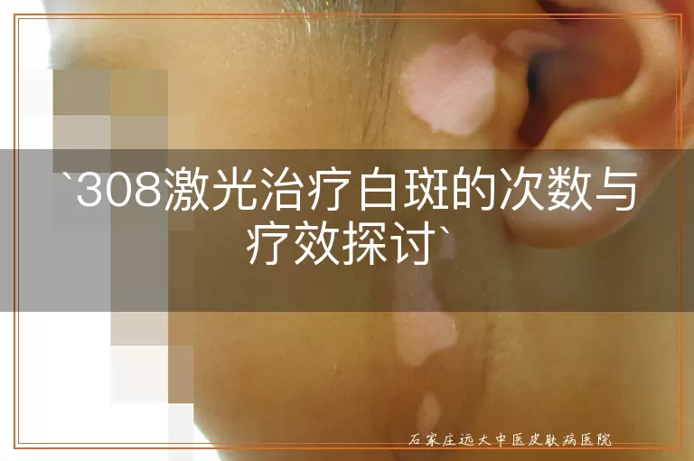 308激光治疗白斑的次数与疗效探讨