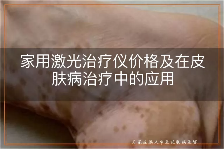 家用激光治疗仪价格及在皮肤病治疗中的应用