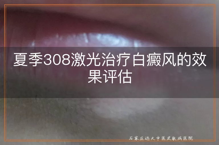 夏季308激光治疗白癜风的效果评估