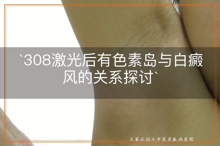 308激光后有色素岛与白癜风的关系探讨