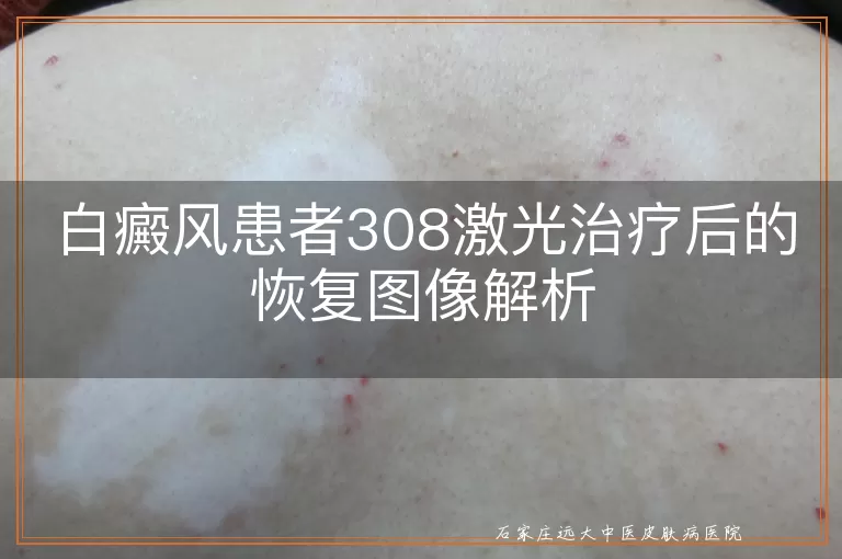 白癜风患者308激光治疗后的恢复图像解析