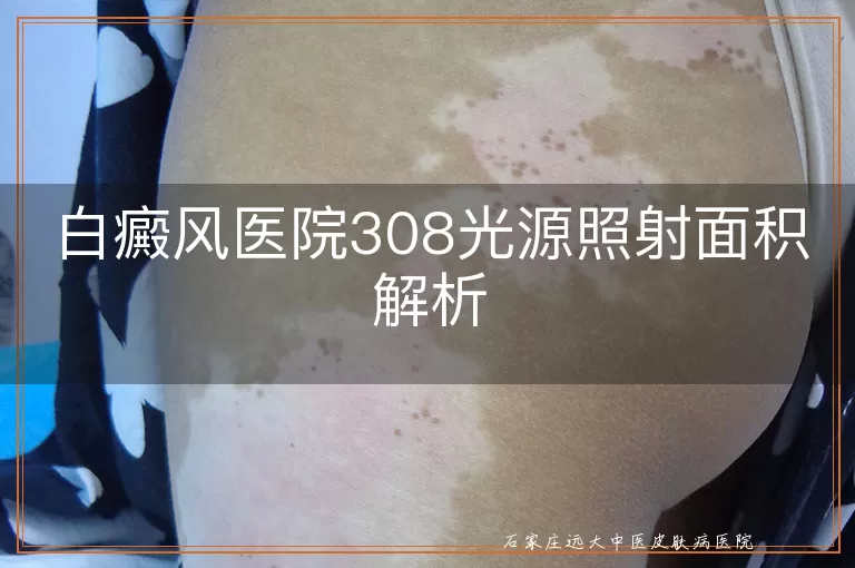 白癜风医院308光源照射面积解析