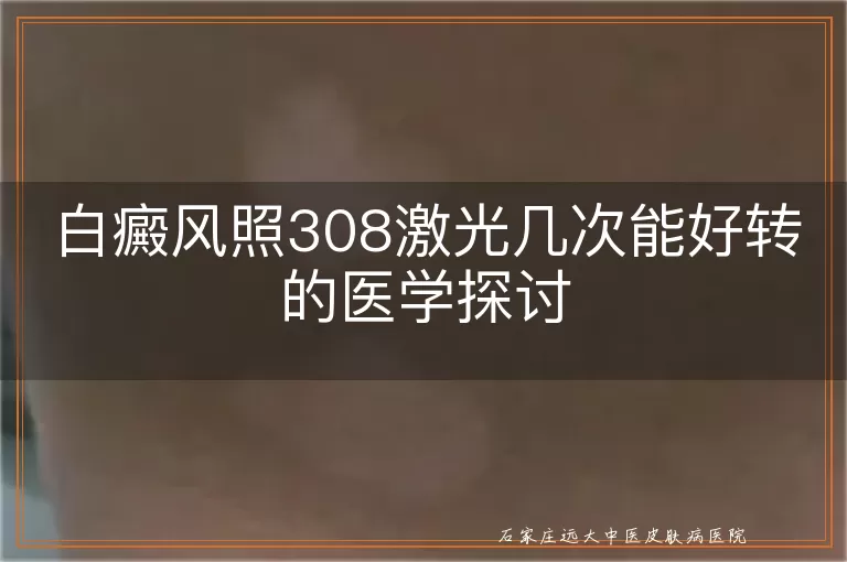 白癜风照308激光几次能好转的医学探讨