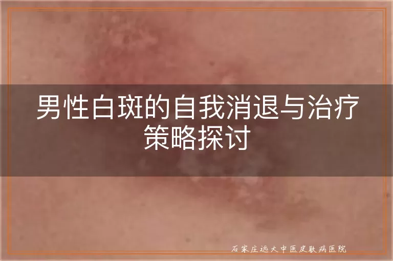 男性白斑的自我消退与治疗策略探讨