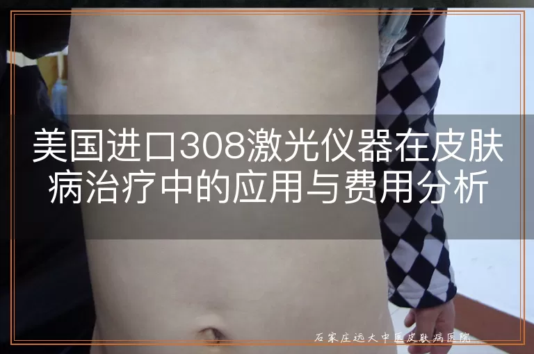 美国进口308激光仪器在皮肤病治疗中的应用与费用分析