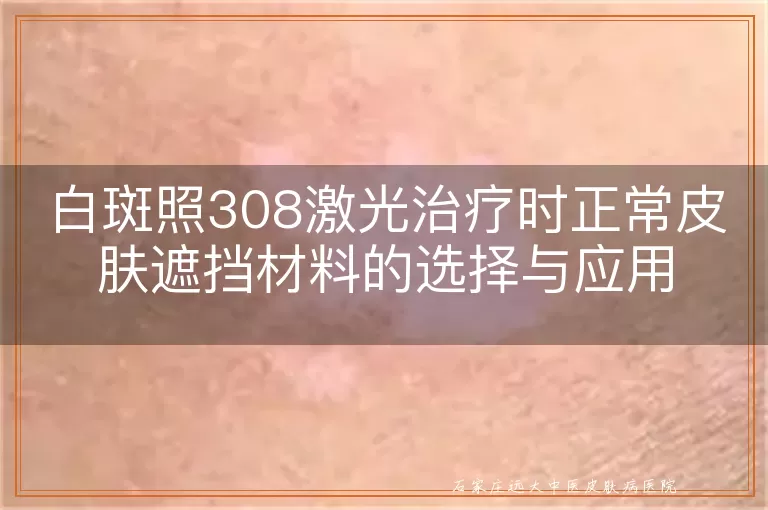 白斑照308激光治疗时正常皮肤遮挡材料的选择与应用