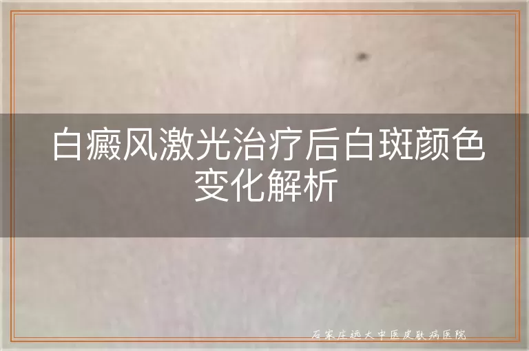 白癜风激光治疗后白斑颜色变化解析