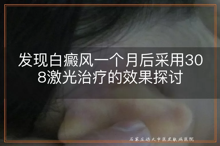 发现白癜风一个月后采用308激光治疗的效果探讨