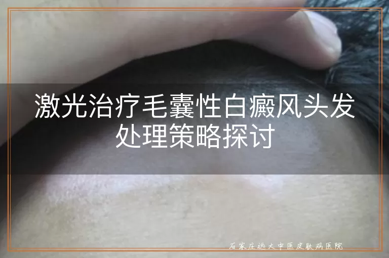 激光治疗毛囊性白癜风头发处理策略探讨