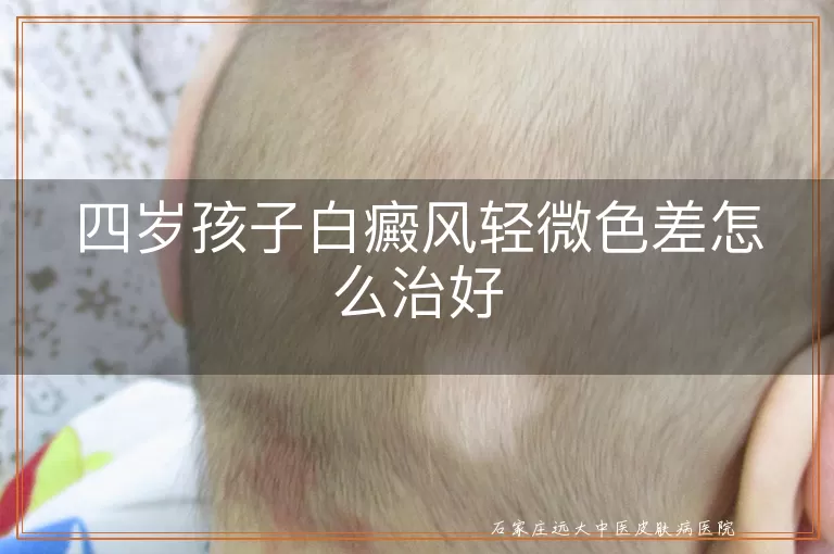 四岁孩子白癜风轻微色差怎么治好