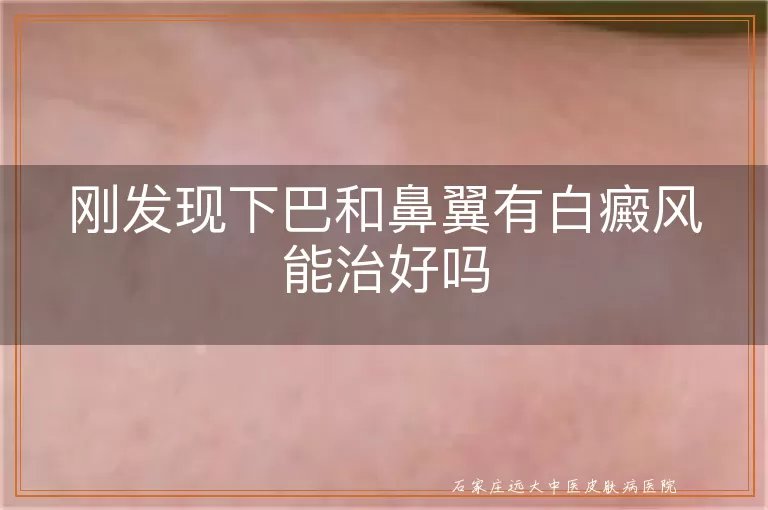 刚发现下巴和鼻翼有白癜风能治好吗
