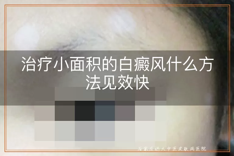 治疗小面积的白癜风什么方法见效快