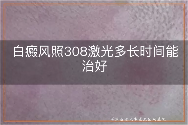 白癜风照308激光多长时间能治好