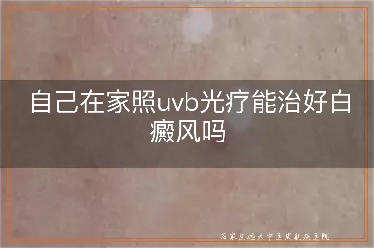 自己在家照uvb光疗能治好白癜风吗